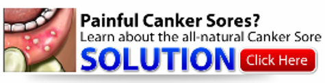 Canker Sore Solution 2
