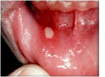 canker sore picture 2