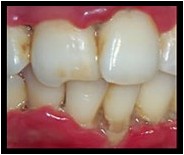Swollen Gums Around Tooth