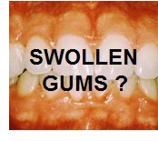 Swollen Gums Around Tooth