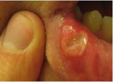 Canker Sores in Mouth