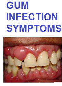 Gum Infection Symptoms