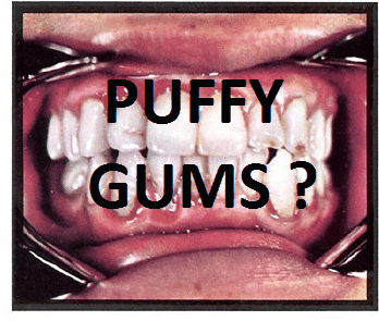 Puffy Gums Treatment